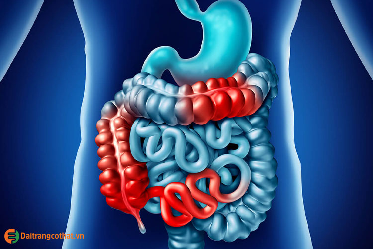 Bệnh Crohn (viêm ruột vùng) 1