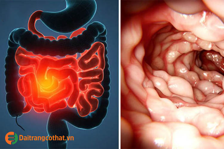 Bệnh Crohn 1